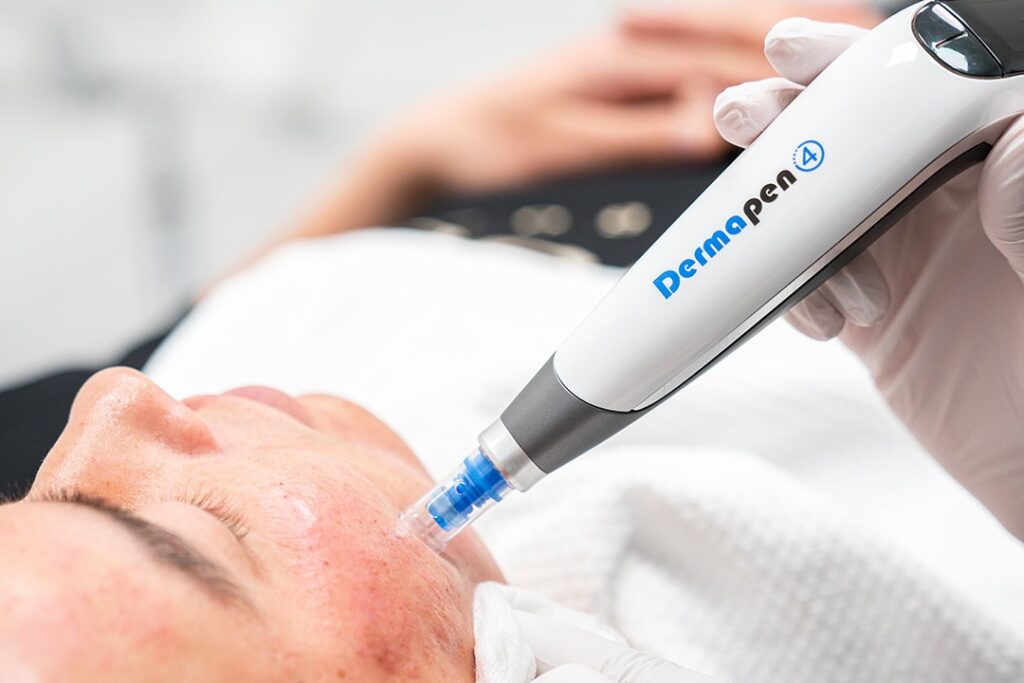 dermapen behandling